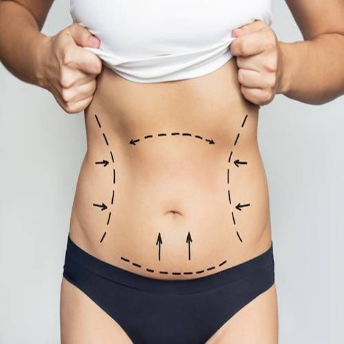 Liposuction Laser